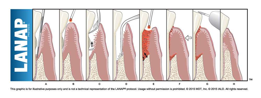 LANAP-steps-image LANAP-steps-image