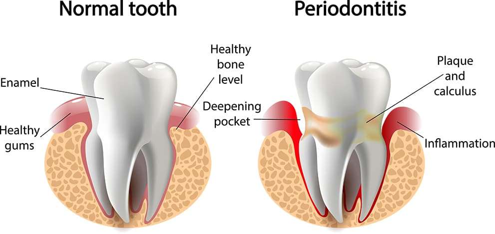 periodontal-disease-diagram periodontal-disease-diagram