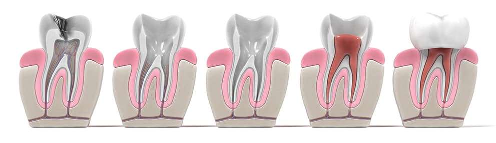 root-canal-steps root-canal-steps