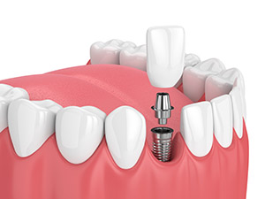 Single Tooth Implant
