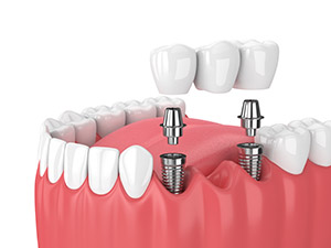 Multiple Tooth Implant