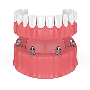 Total Teeth Implant